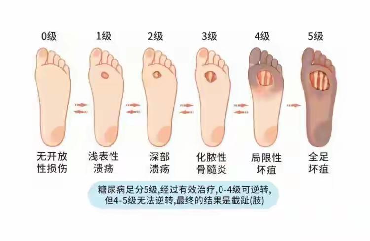谁能想到？一个糖尿病患者剪趾甲弄破点皮，两年就没了10根脚趾，现在连手指都全发黑