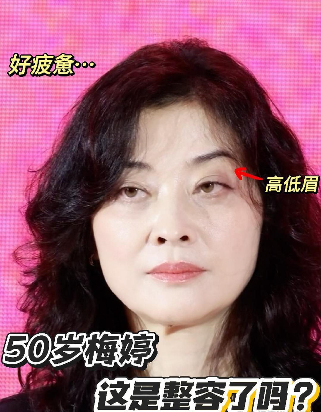 梅婷这是去整容了吗？面部僵硬，双眼无神像是熬了几天大夜，眼皮耷拉下来都快粘在