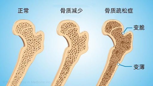 如何提高骨密度？Claude对此解答：骨密度这个问题很多人到出问题才关注，其实干