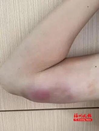 13岁男孩频繁接触流浪猫，手臂突然鼓起“大包”？医生判断避免一场动刀这下后悔了