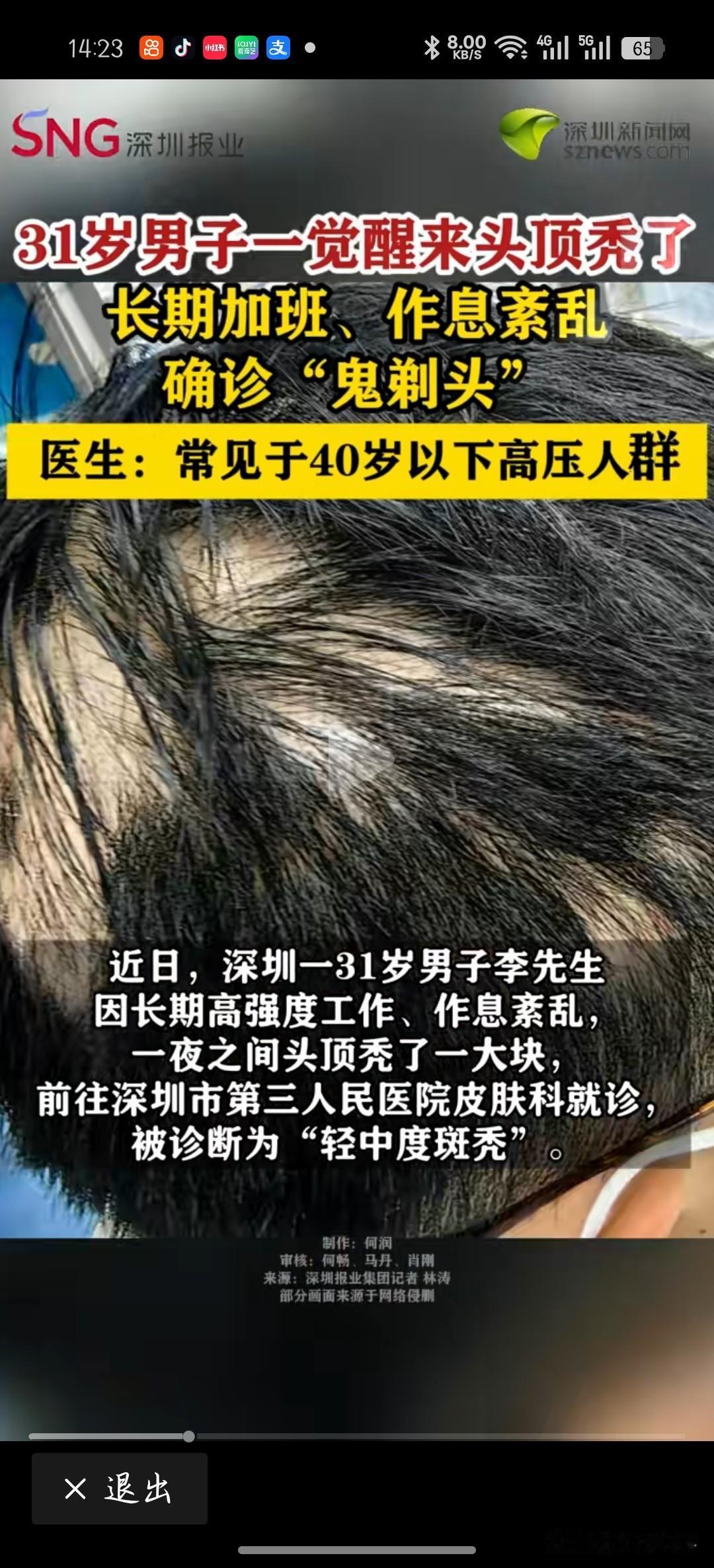 “活久见！”近日，深圳一31岁男子因长期高强度工作、作息紊乱，一夜之间头顶秃了一
