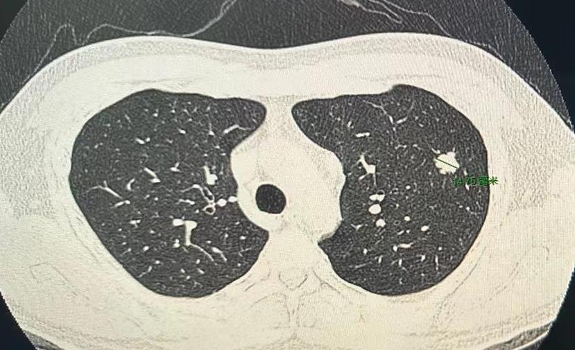 门诊看了五十多位患者，连着做了五台手术，有一台让我心情特别沉重！一位才33岁的小