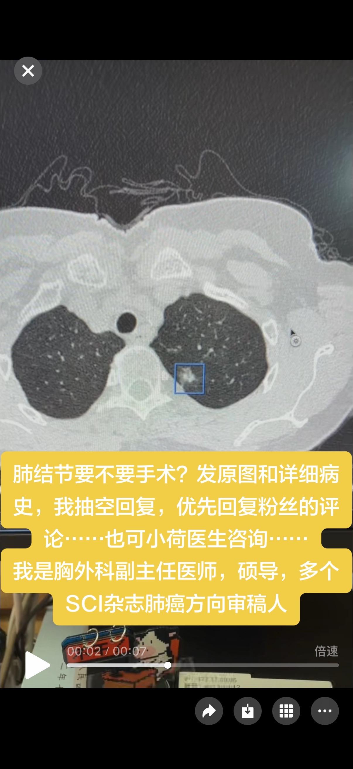 肺结节要不要手术？发原图和详细病史，我抽空回复，优先回复粉丝的评论……...