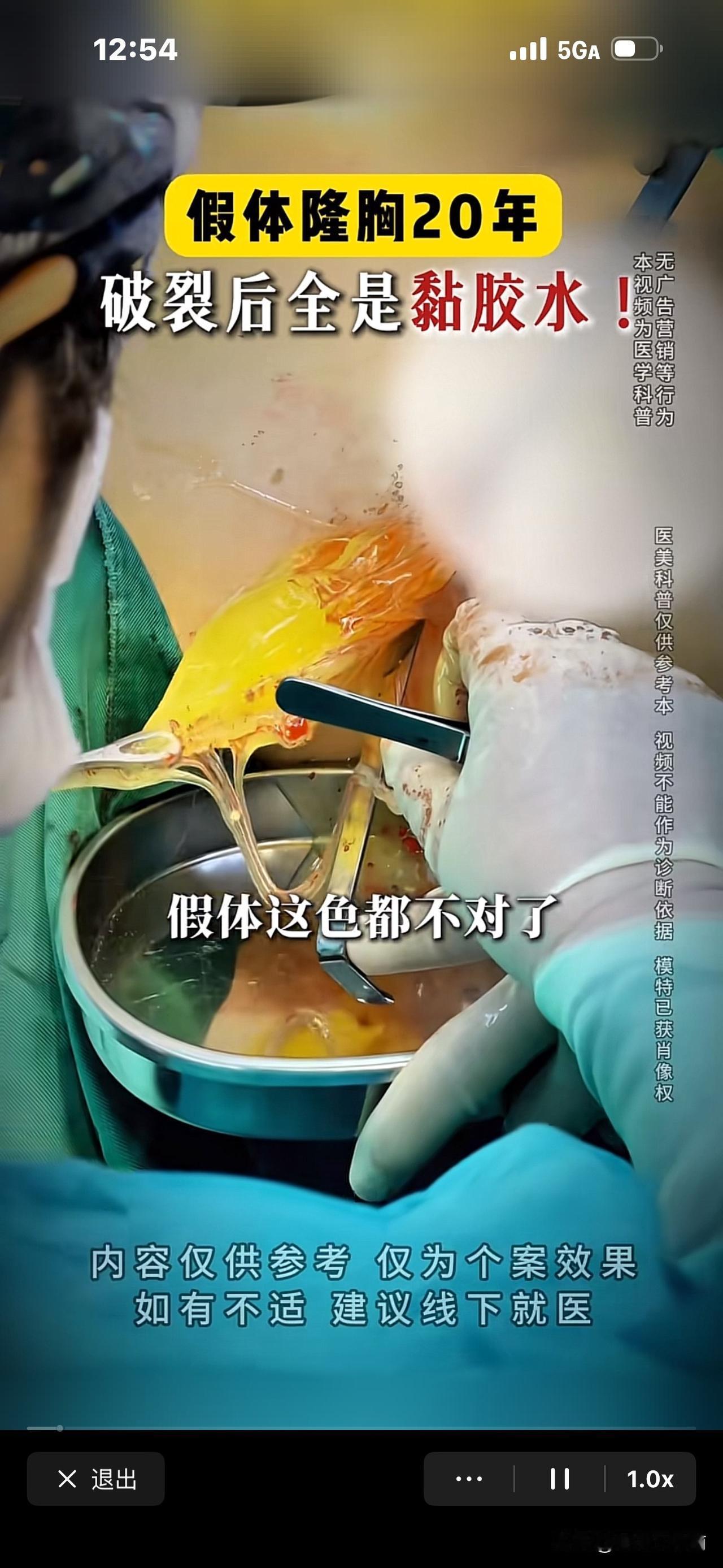 隆胸20年，取出假体！瞧，它已破了，没有形状，流出来像520胶水。一位整