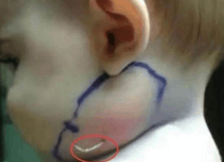 婴儿脖子下长出类似羽毛的东西, 拔出来一看, 妈妈很自责