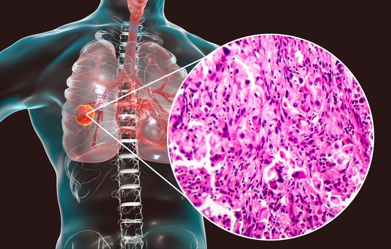 不知不觉就得了晚期肺癌，有人甚至觉得自己很健康，其实早有预兆毫无症状的晚期肺癌