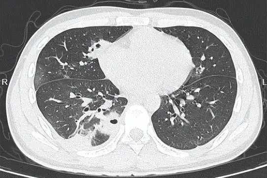 吓懵！浙江20岁男生挤了颗痘，肺被“啃”出10多个空洞！医生：这地方的痘，挤了可