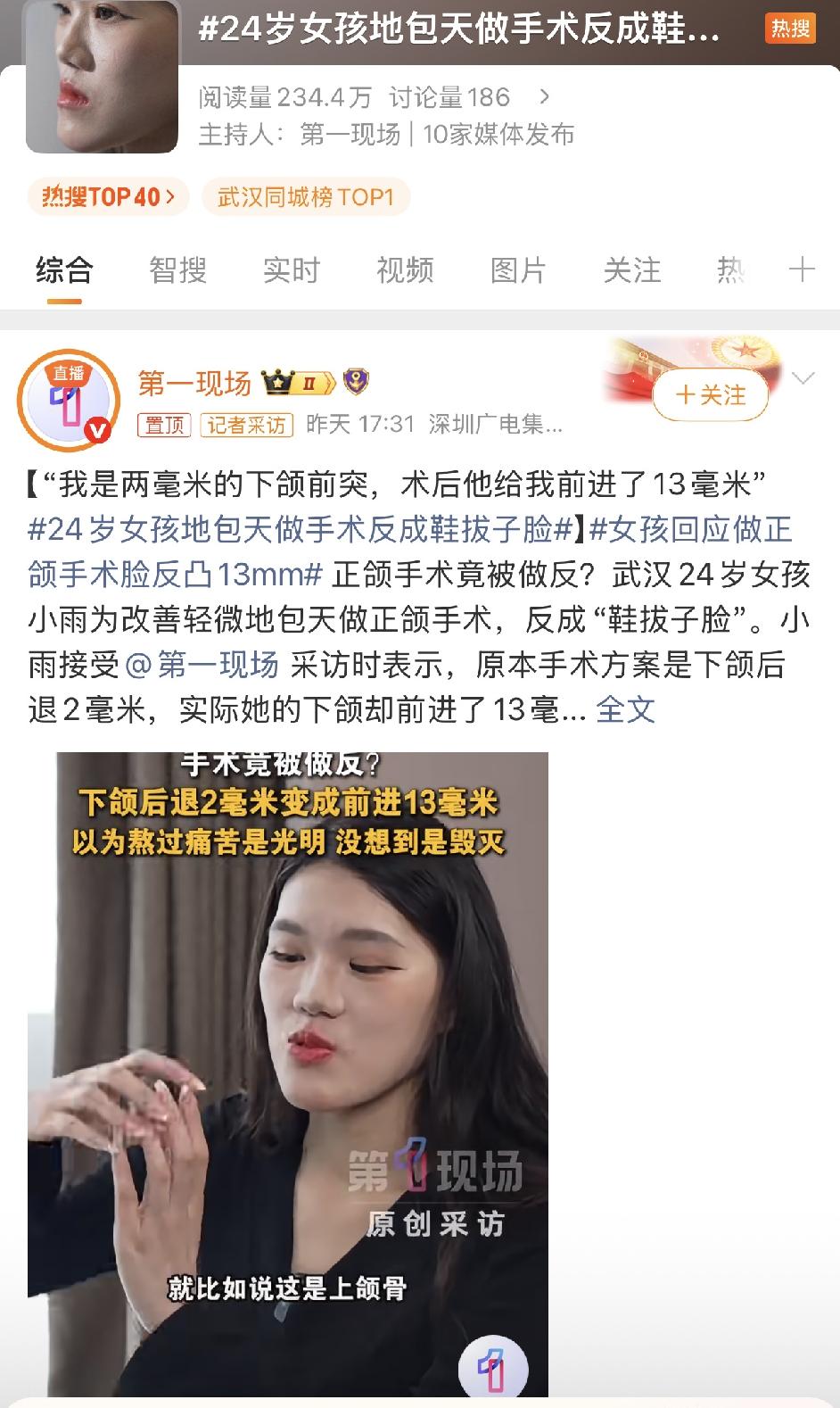 武汉24岁女孩小雨本想微调2毫米的轻微地包天，术后却因医生反向操作变成严重的“鞋