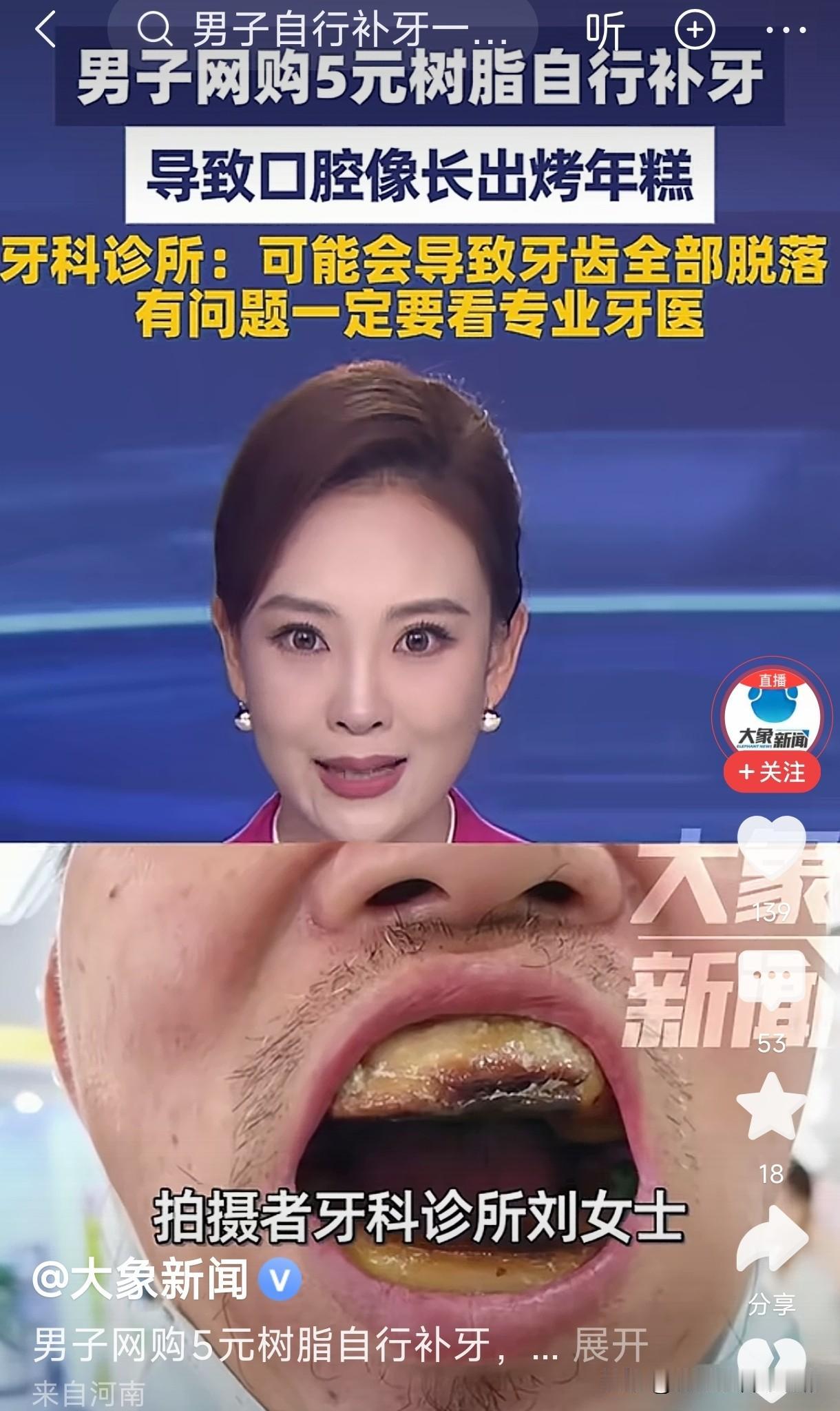 生而为人有时真的很艰难，天津的一位大叔牙齿坏了舍不得花钱去诊所镶牙。自己买了几块