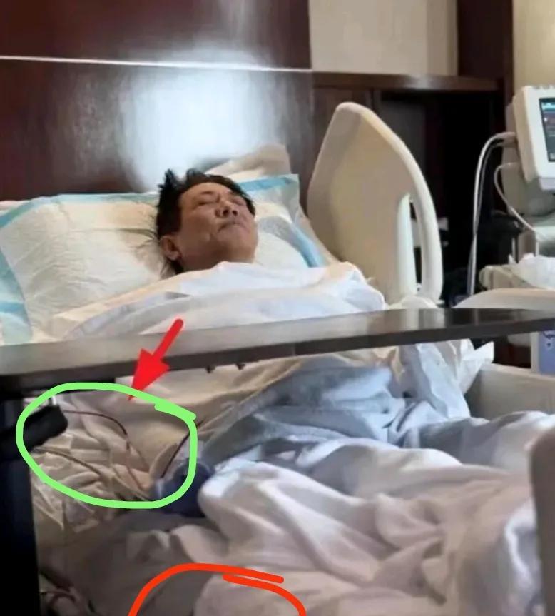 据向太透露，李连杰这次是腹部长了一个良性肉瘤，但没说具体位置。看他那张病床照片