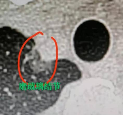 不是所有肺浸润性腺癌都可怕，很多情况下不仅有治愈的可能，预后还特别好。今天就给大