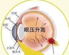 青光眼是什么, 早期症状有哪些