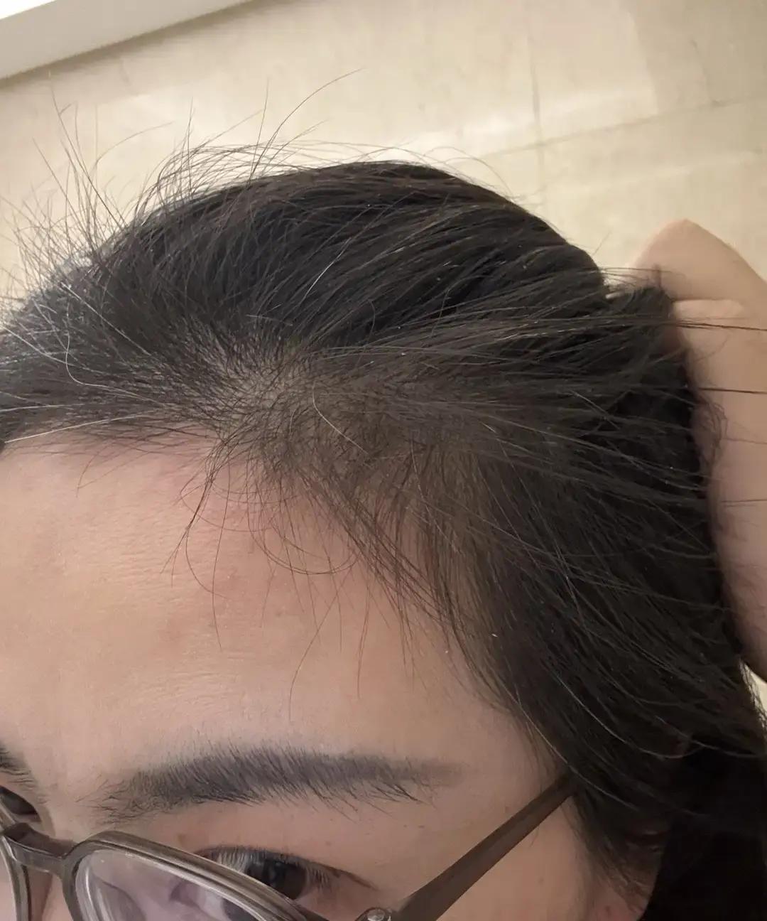 我试了三个月食疗，从九月开始。现在白发慢慢变灰，还长出新绒发。这事我得说说。