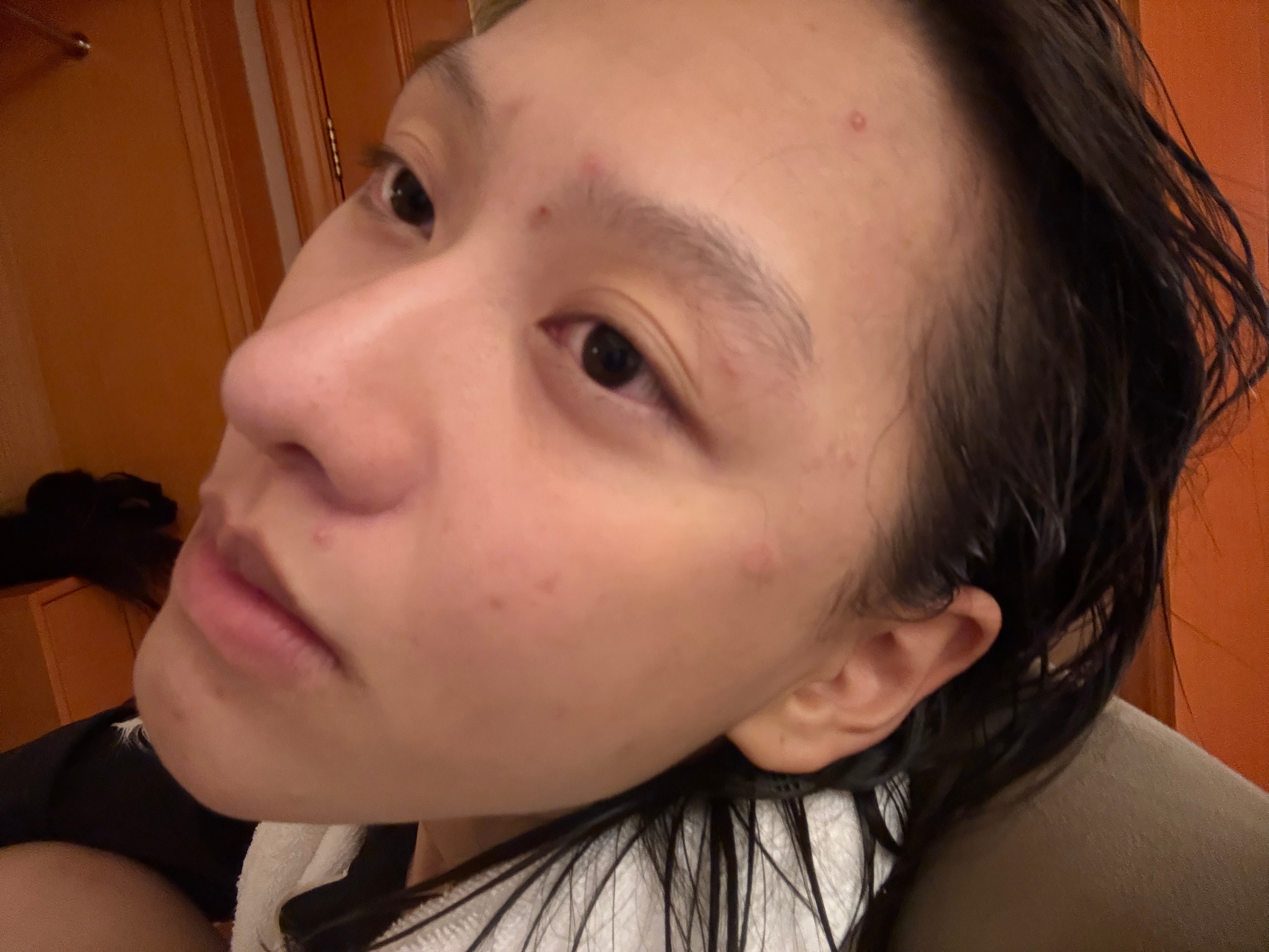 近期爆痘中​​​
