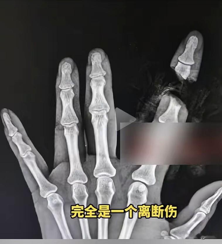这得和自己有多大仇啊，下手才会这么狠！女子在家剁排骨时，生生将左手食指给剁下去