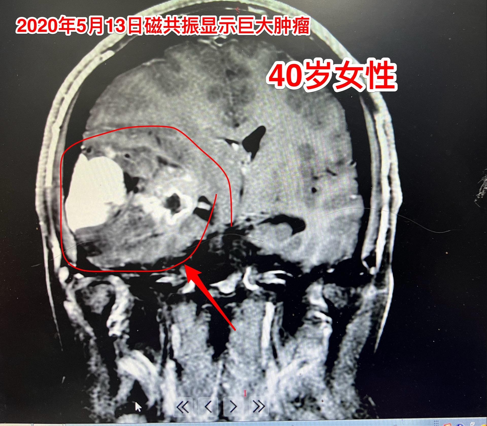 高级别胶质瘤要争取完全切除。新年上班第二天，今天收到一个胶质瘤病人手术...