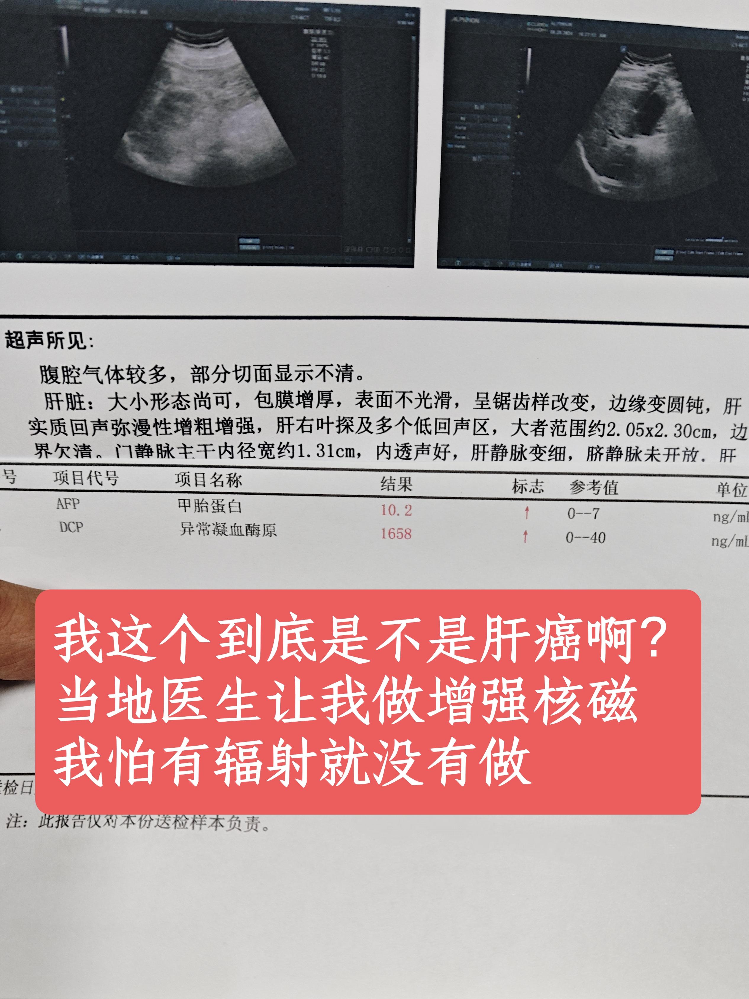 我一直有乙肝，上个月去复查的时候，被告知肝脏里面长了个结节，我看也才1...