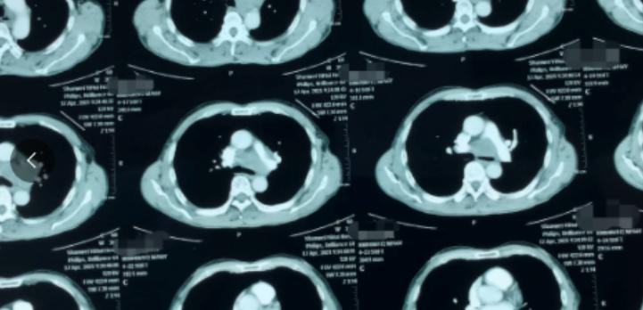 患者半年前CT体检完全正常，仅仅半年后再检查，就已是肺癌晚期。这种情况在我临