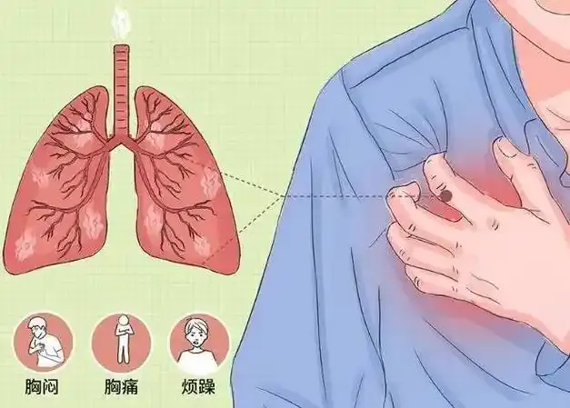 两位肺癌病人想活到100岁, 医生说有可能, 毕竟MIA不复发