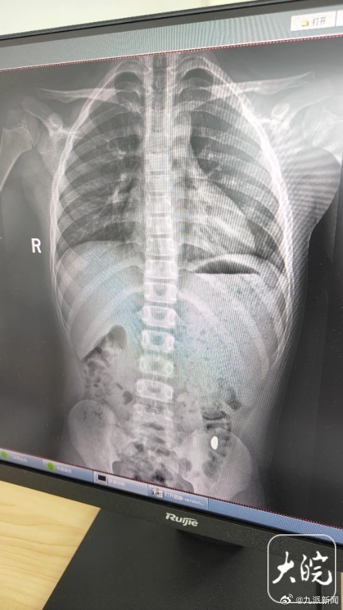 万元金豆被熊孩子吞下！妈妈守厕5天终淘金成功
