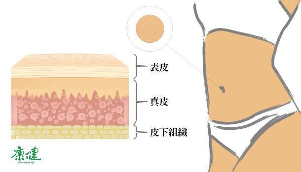 “减肥肚脐贴”真有其效? 医师这样打脸