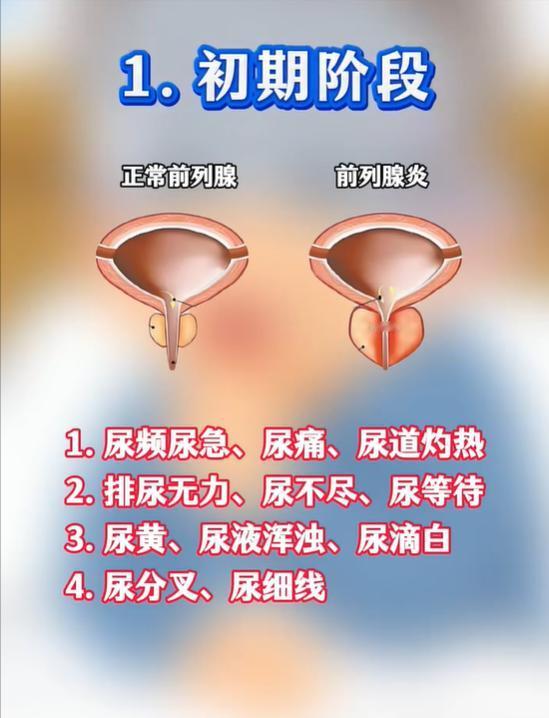 前列腺不适，大致分为这三个阶段