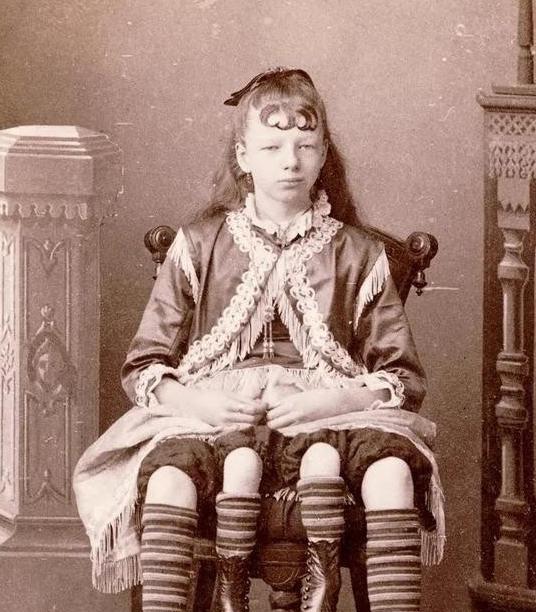 这个女人有4条腿，肚脐以上和普通人没区别，肚脐以下的器官都有2套：2个盆骨、2个