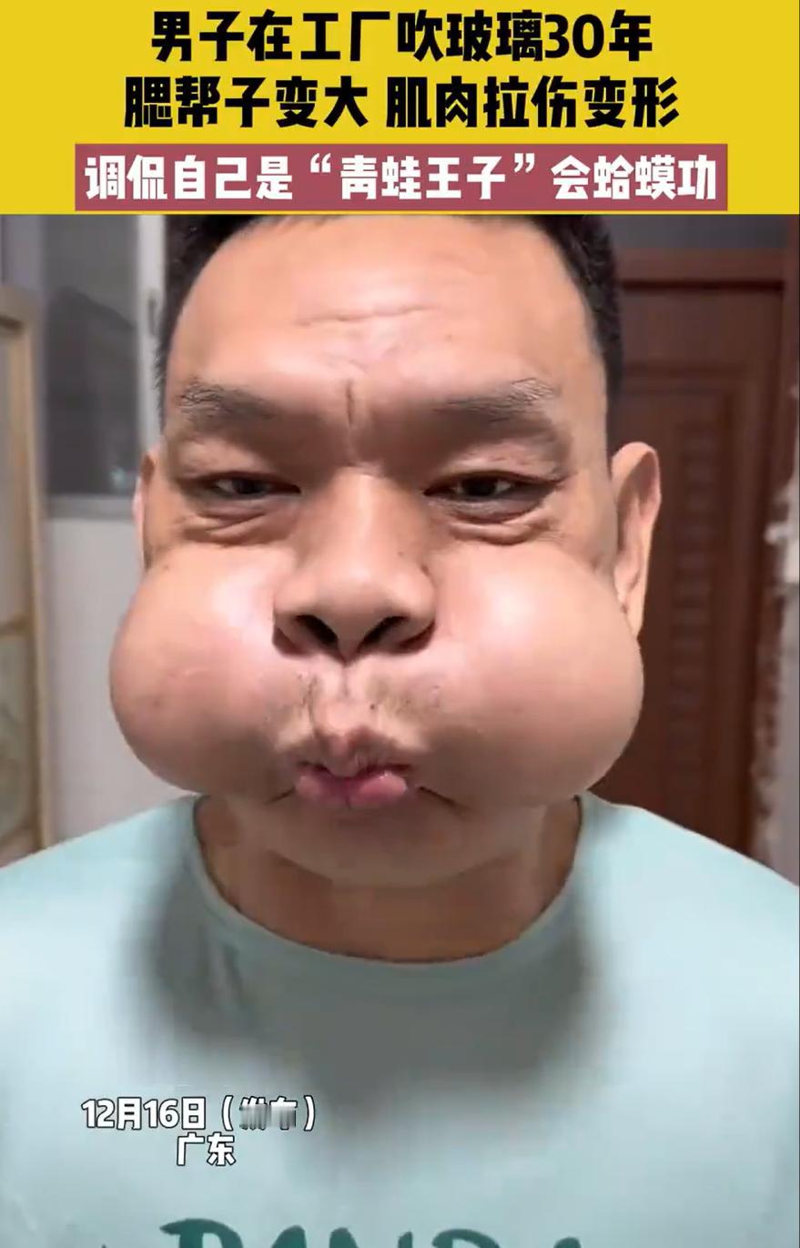 “这个真笑不出来！”广东，一男子在工厂干活干了30年，因为常年都要吹玻璃，导致两