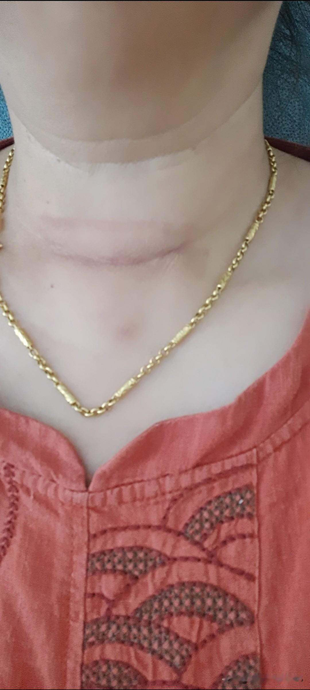 自从脖子上留下这个印记，必须服用优甲乐后，感觉整个人都变得不好了。昨晚