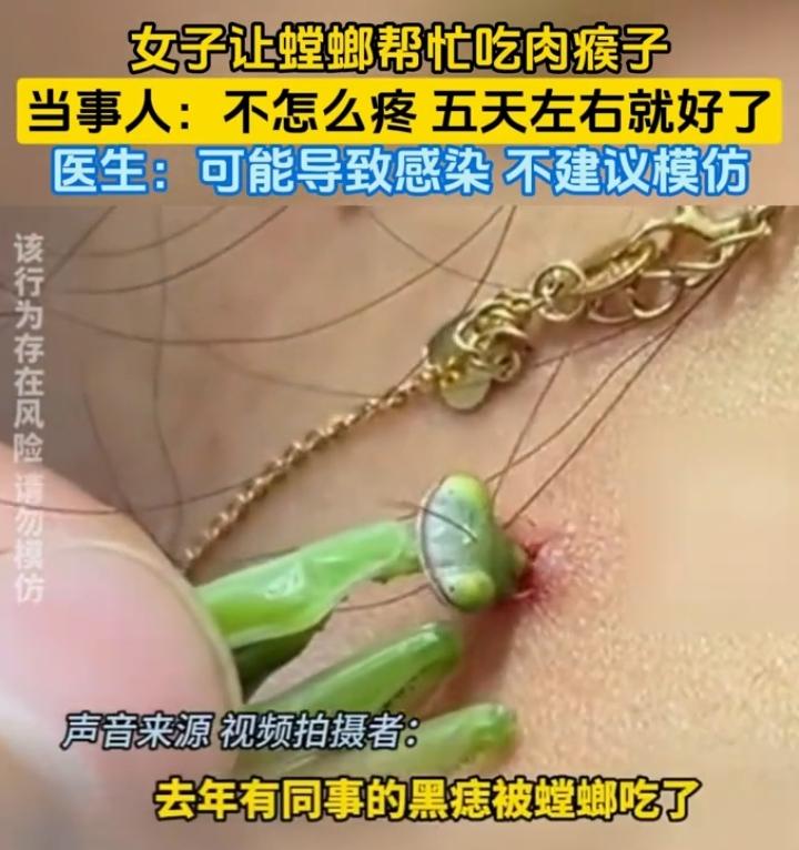 近日有位女子脑洞大开，找来螳螂帮忙处理身上的肉瘊子，奇葩操作引来不少围观。只见小