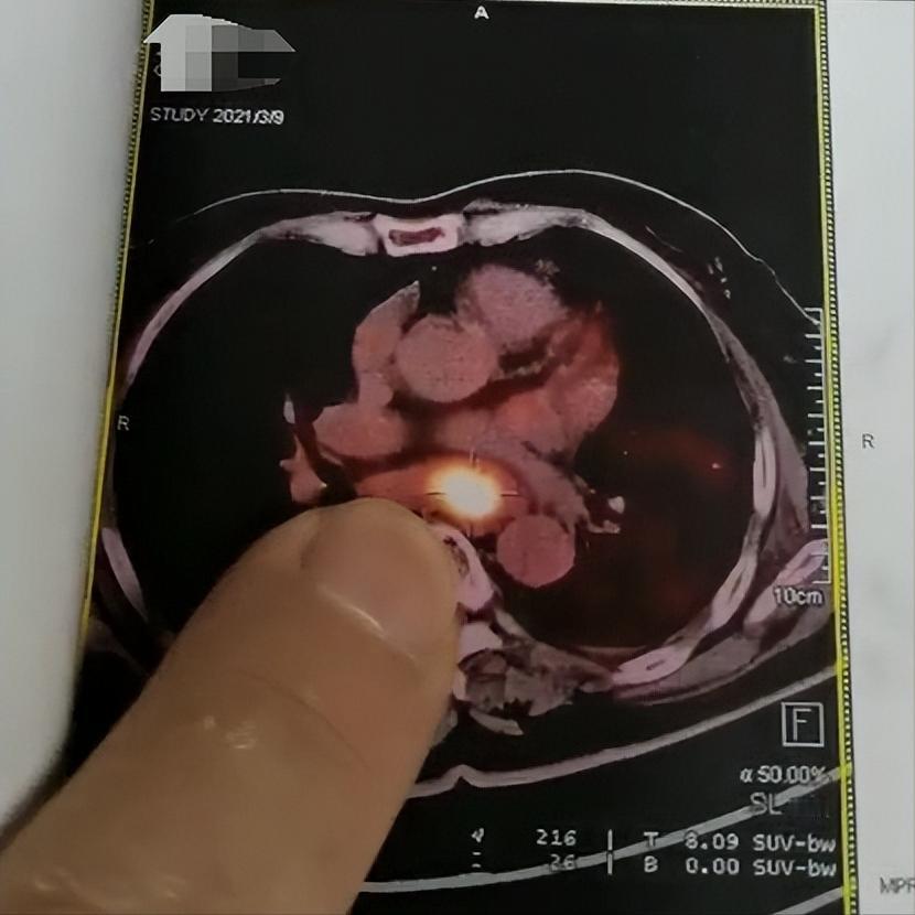 长期口臭，查出癌症！今年53岁的杨先生，因为口臭去口腔医院就诊，本以为是小问题，