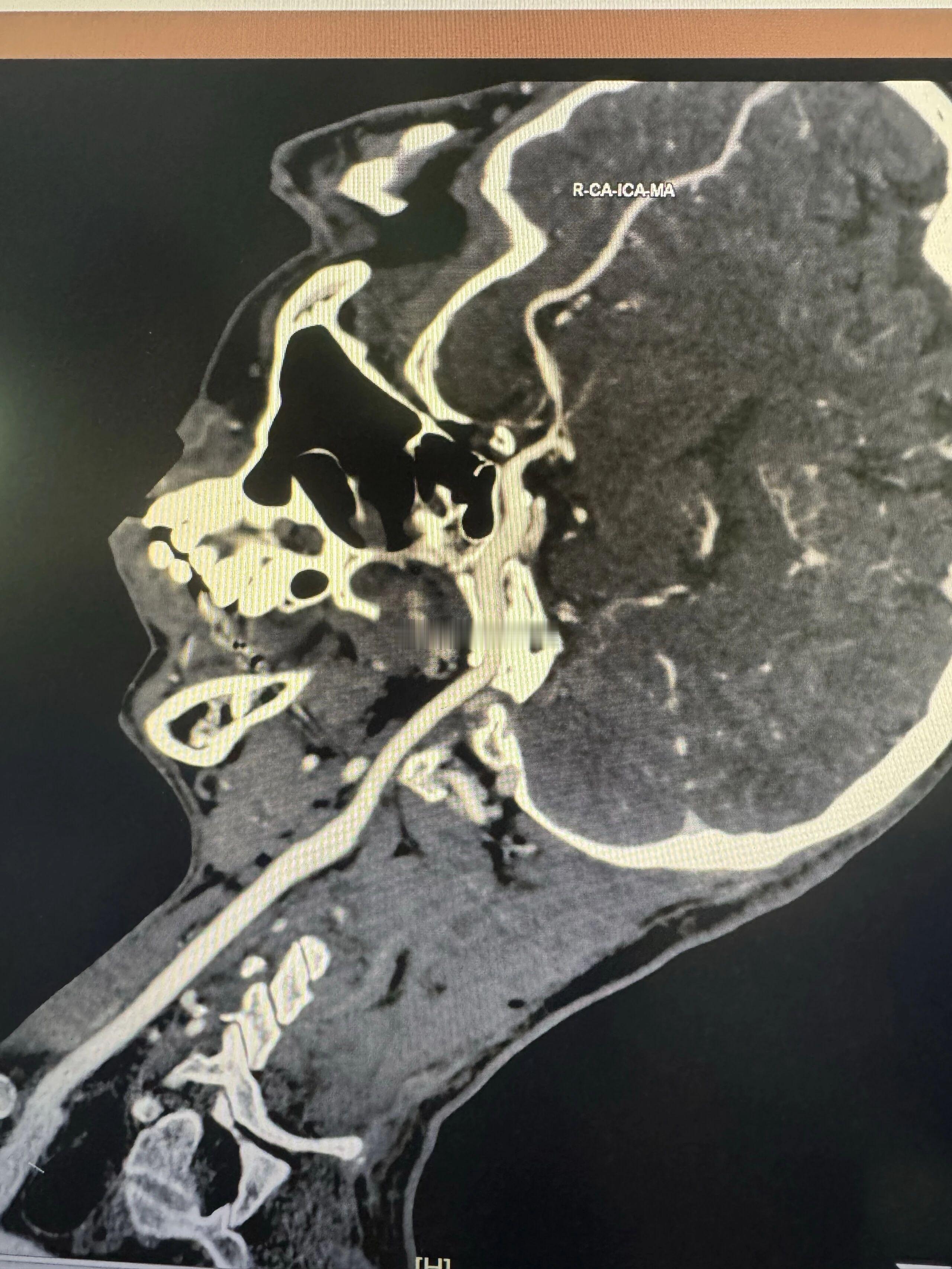 上上周跟颜老师门诊抄方，老师聊到她刚见的一位同学，谈到对手术的看法，老师这位同学