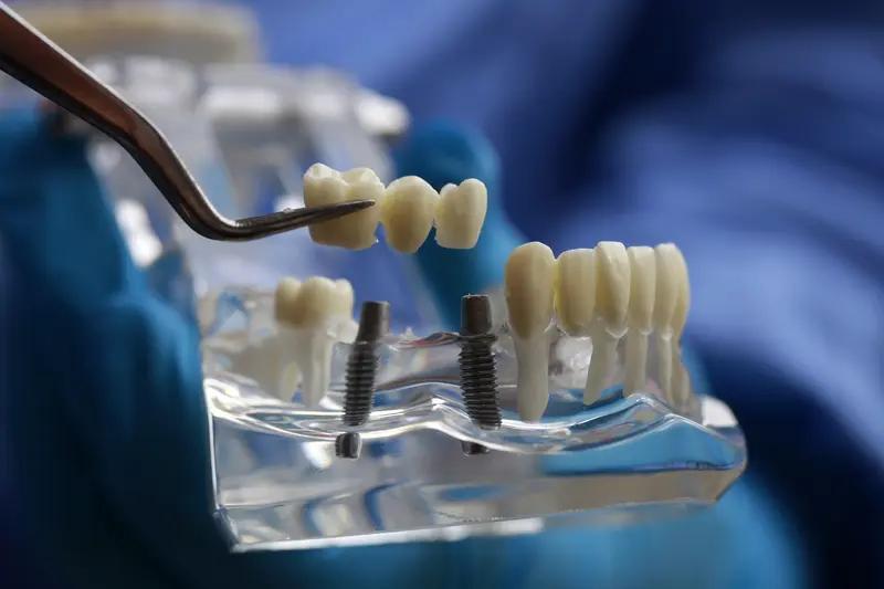 种植牙这遭罪的事儿，我算是深刻体会了。现在正经历植骨粉打桩，那滋味真不好受。手术