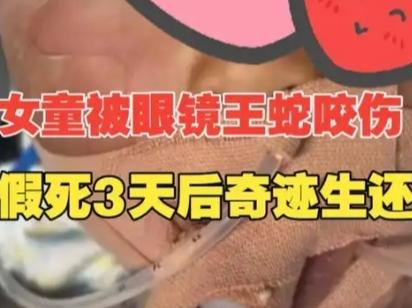 云南3岁女童被眼镜王蛇咬伤