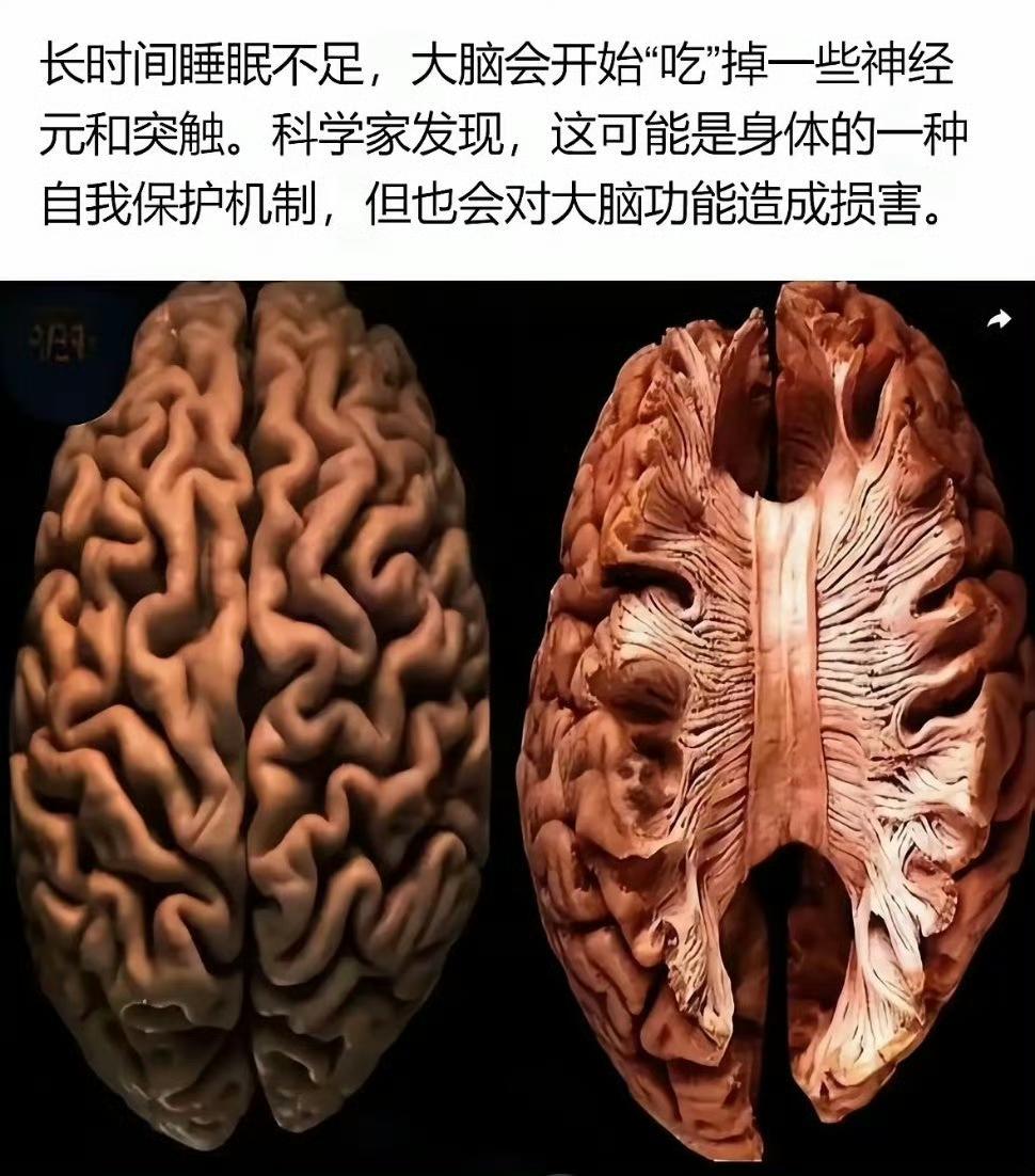 怪不得睡眠不足的时候容易头疼​​​