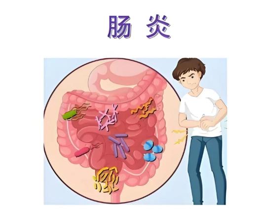慢性结肠炎的4大典型症状，快看看你有没有第一，反复腹泻，这是慢性结肠炎最早期最