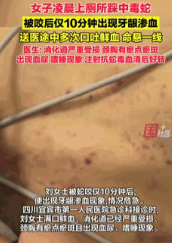 云南，60岁女子凌晨上厕所踩中毒蛇，仅10分钟后出现牙龈渗血！最可怕的是，女子并