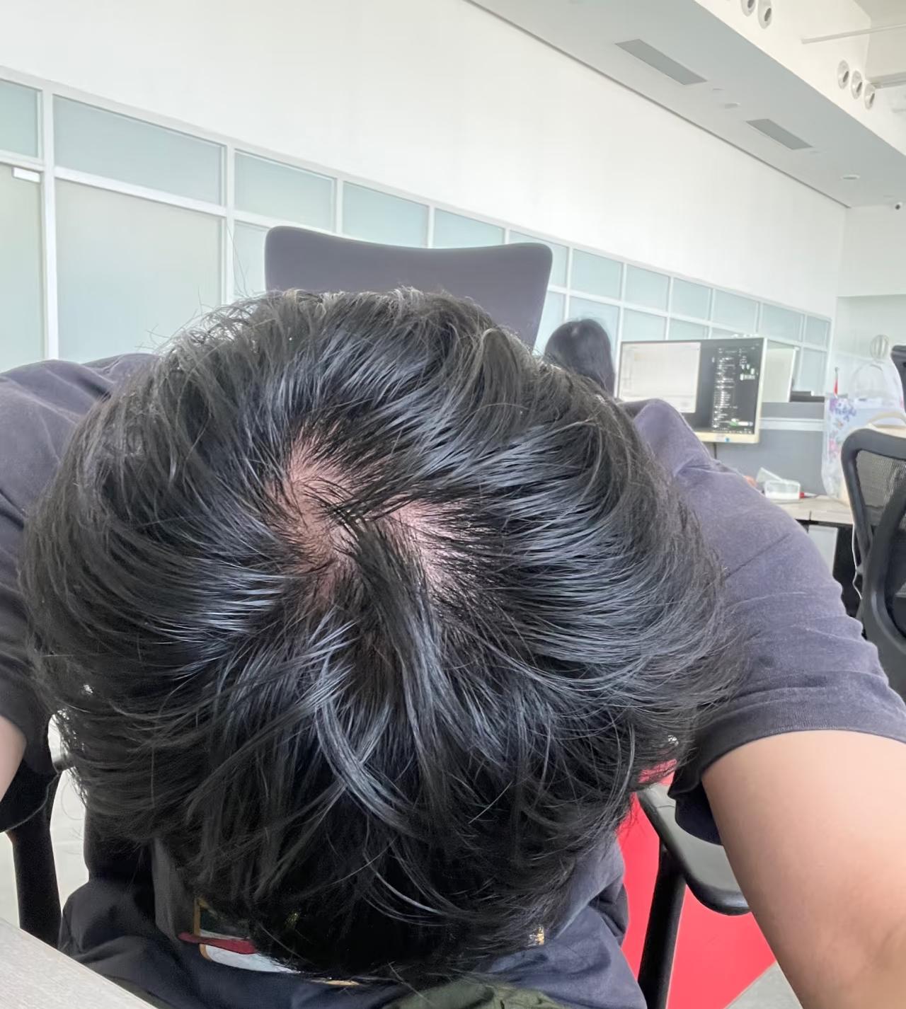 男性秃顶，其实就这3种“宿命”！对照一下你是哪一种？老铁们，是不是发现发际线