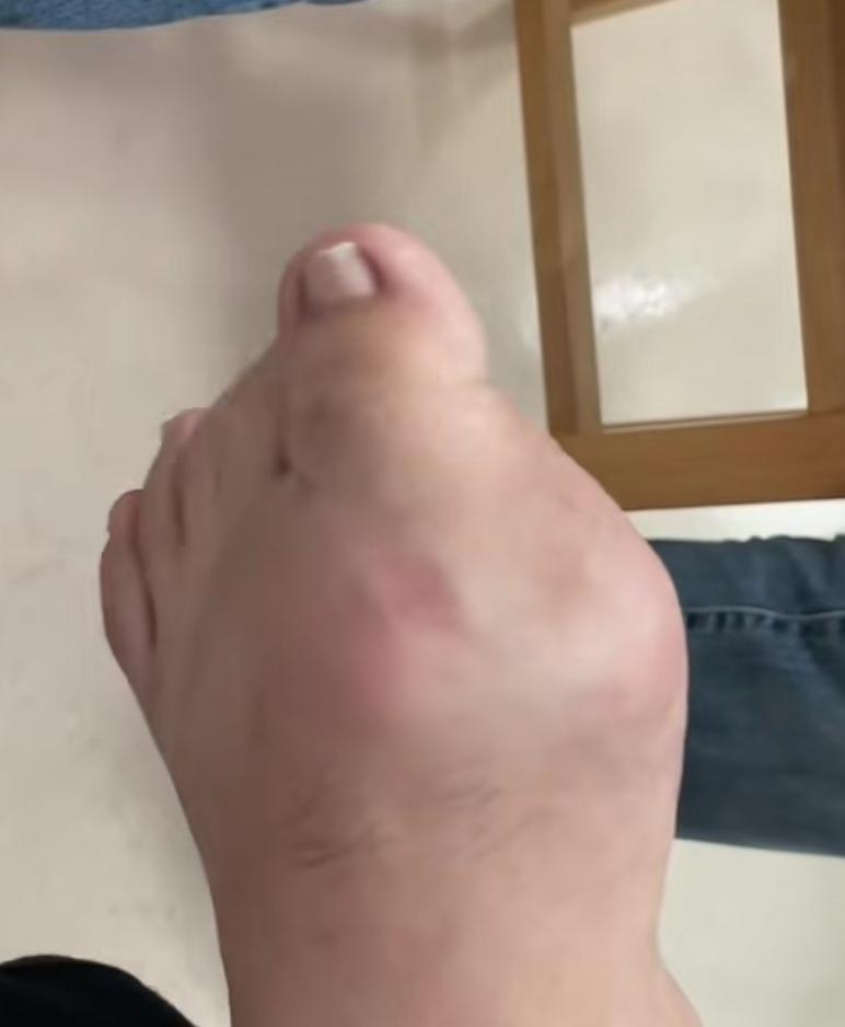 大口地吃肉，大口地喝酒，爽了再来吃止痛药，这是痛风患者的共识。西