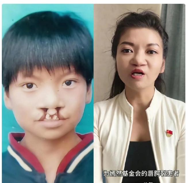 从沉默到呐喊：七千唇腭裂患者的感恩逆袭，李亚鹏直播间背后的温暖力量