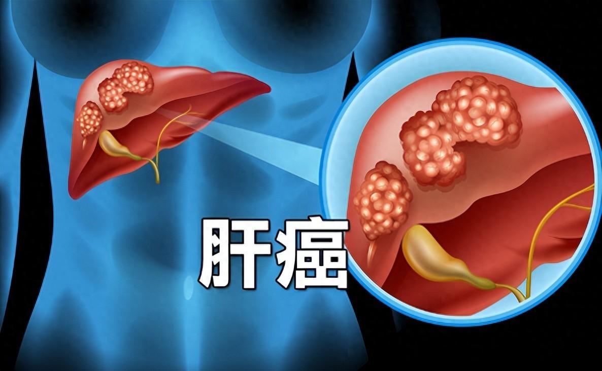研究500名肝癌患者,发现肝癌规律:易患病的人或有4个共性我国每年因饮食不当引