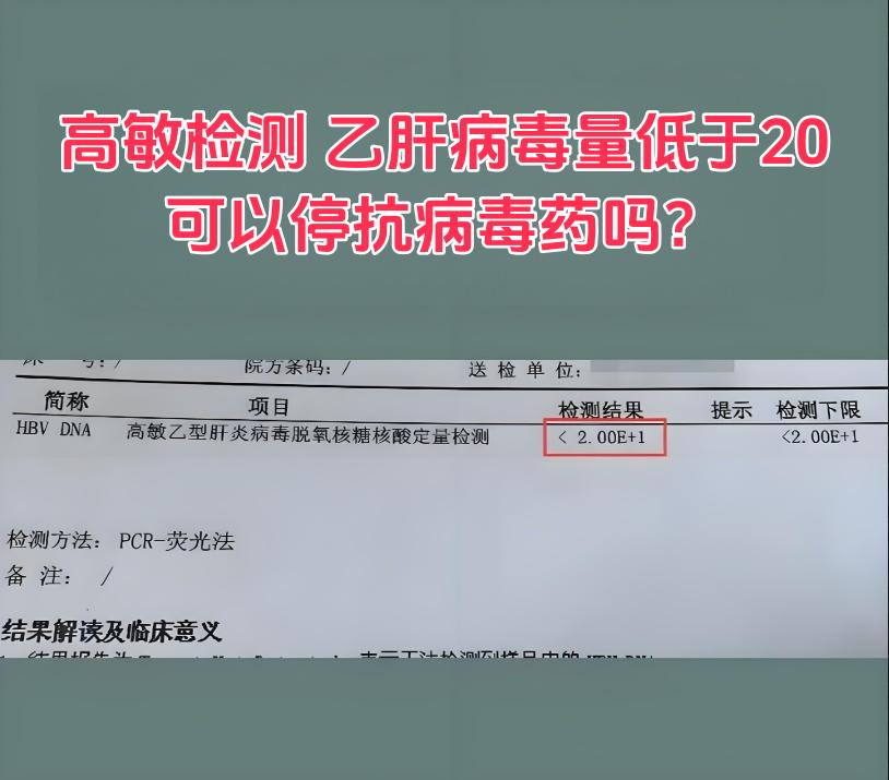 高敏检测乙肝病毒量低于20，可以停抗病毒药吗？ 这是昨天一位山东齐河的...