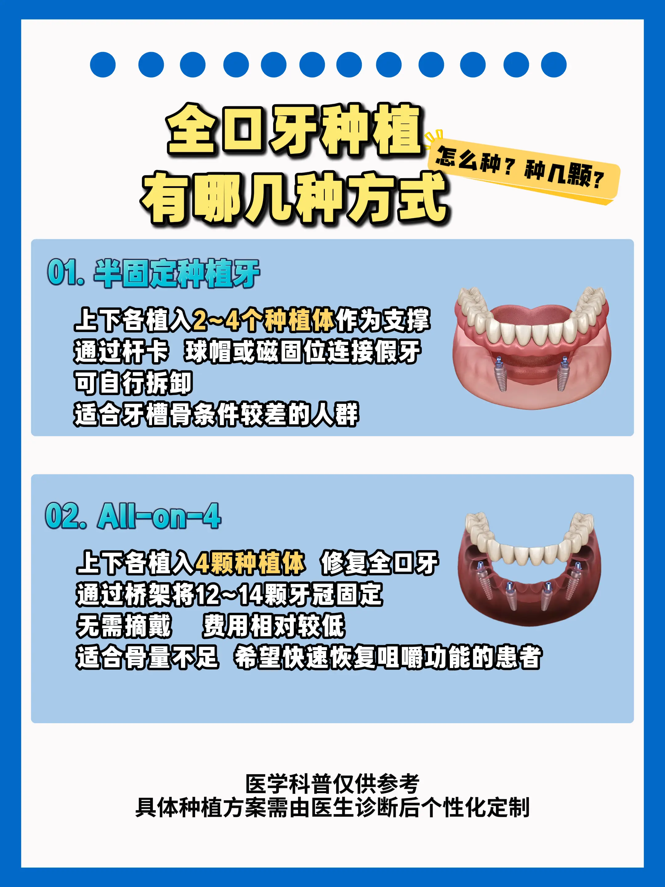 全口种植牙有哪几种方式？种几颗？怎么种？。