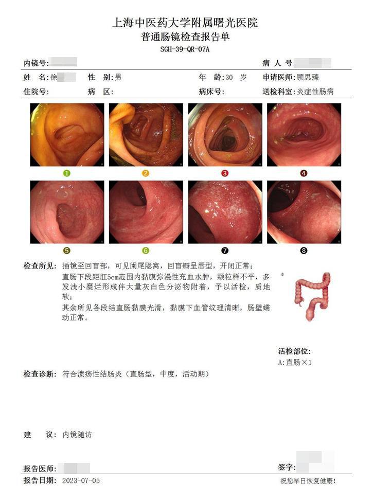 7年溃疡性结肠炎，终在坚持下迎来黏膜愈合。这位患者2018年左右确诊溃...
