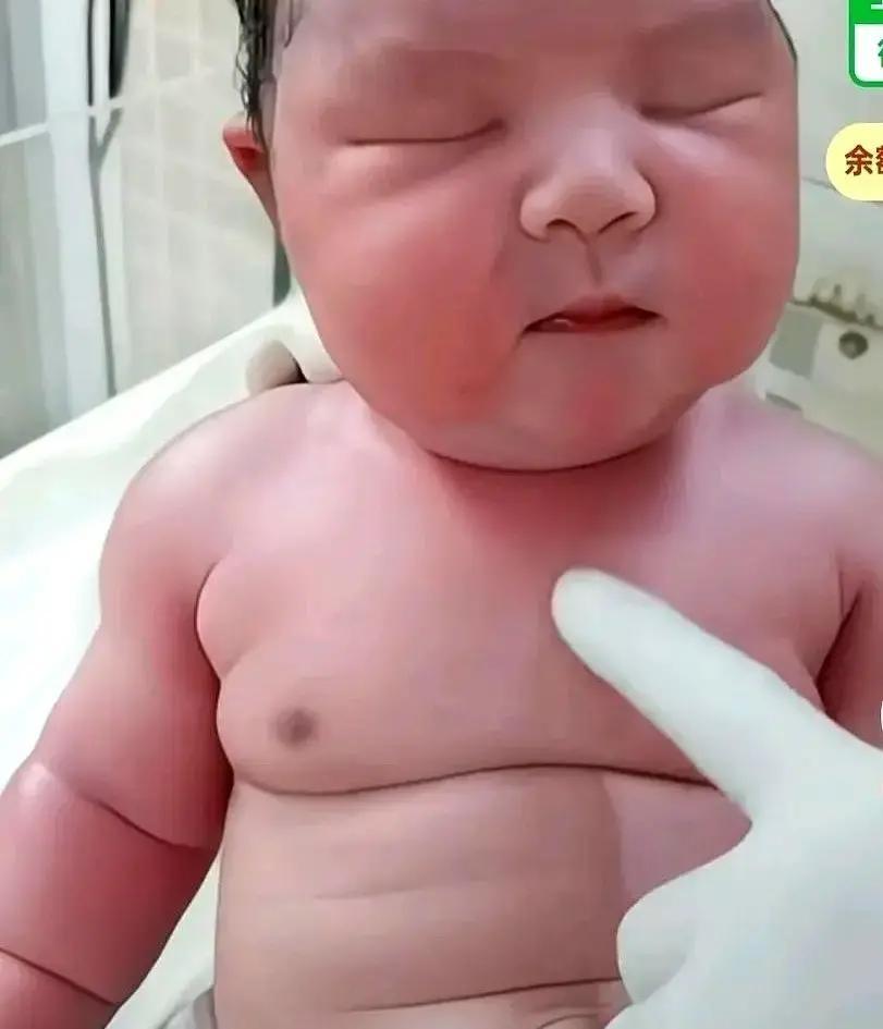 刷到一条说11斤多的男婴顺产出来不哭不闹，还稳稳坐着，脐带都没剪，医生护士全看傻