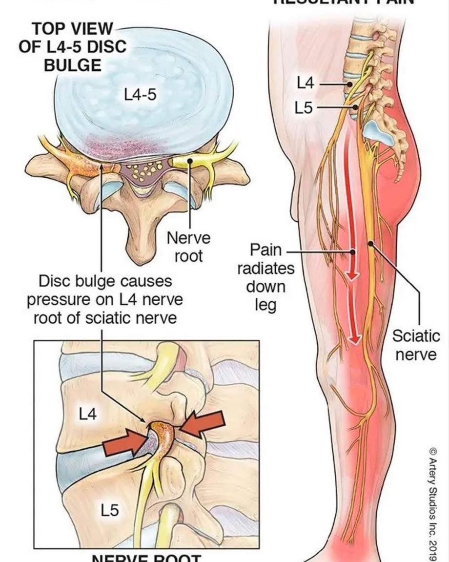腰椎间盘突出﻿﻿腰突中特别常见的一种：L4-L5椎间盘突出——突出的椎间盘，