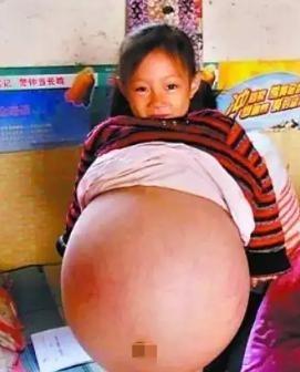 2010年，山西4岁女孩肚子涨大得像孕妇，医生预言活不过三个月，父母深感绝望，就