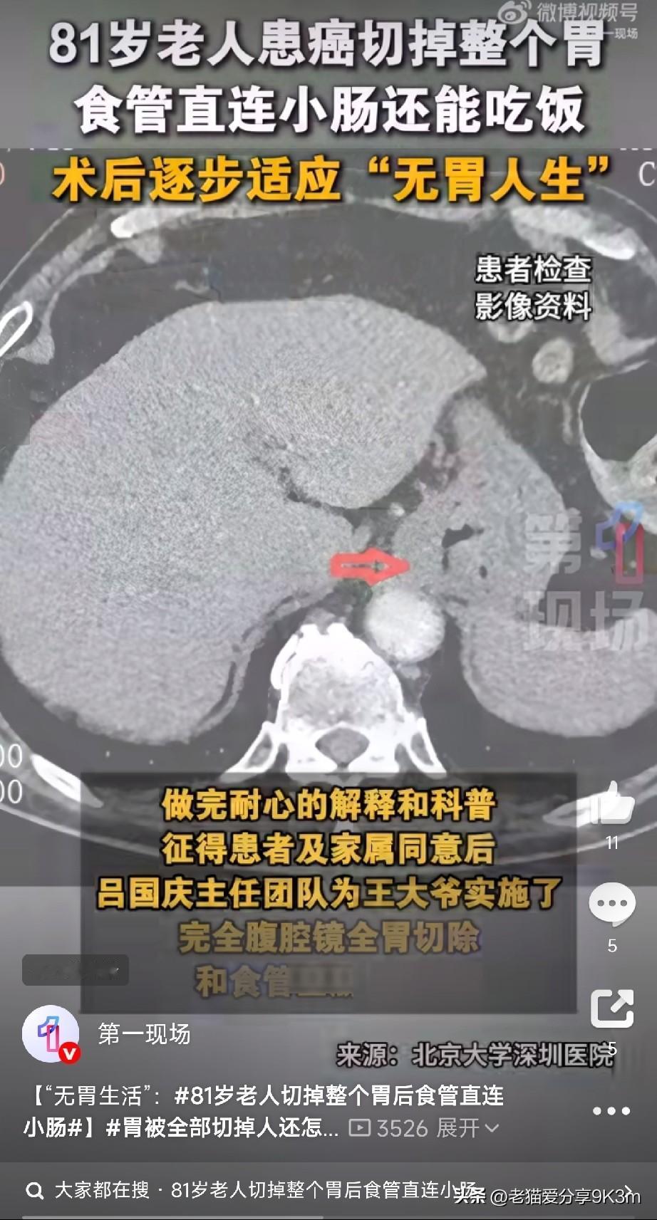 “无胃”也能活！“胃都没了，人还怎么吃饭？不得活活饿死吗？”这是81岁王