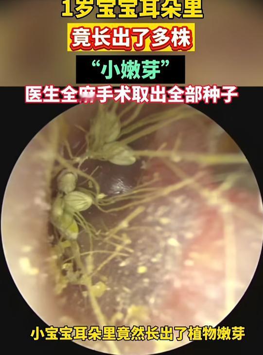 “万万没想到！”8月26日消息，北京有个小宝宝老是挠耳朵。某天家长在孩子耳道口发