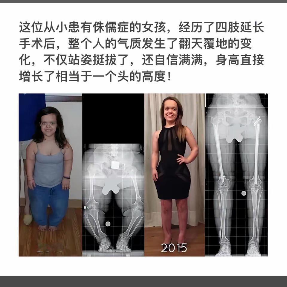 从2010到2015，四肢延长手术让她的气质焕然一新！